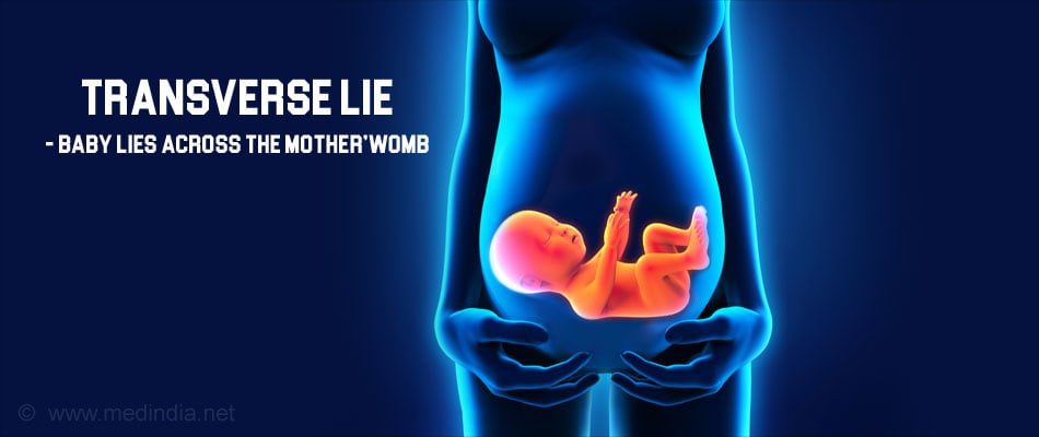 Transverse Lie - Abnormal Position of the Baby Transverse Lie - Abnormal Position of the Baby