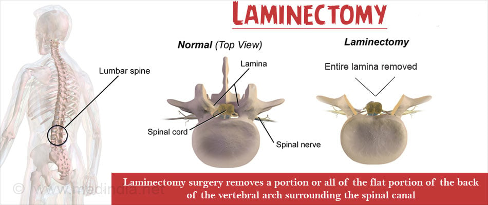 Laminectomy Types Procedure Recovery Risks 