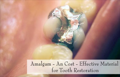 Amalgam used in Tooth Restoration Amalgam used in Tooth Restoration