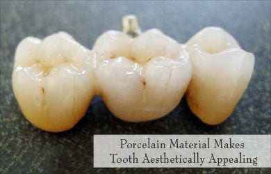 Porcelain Material used in Tooth Restoration Porcelain Material used in Tooth Restoration