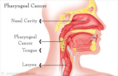 Pharynx Cancer Pharynx Cancer