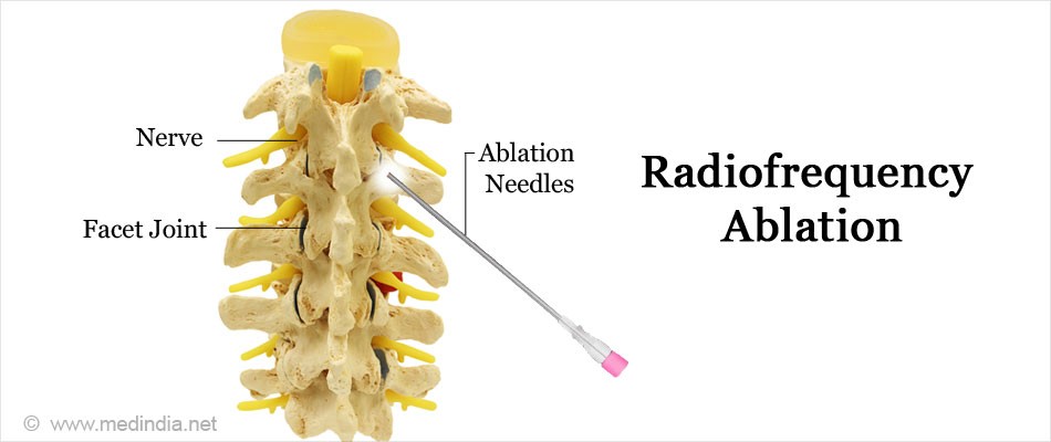 Rhizotomy - Procedures, Risks & Complications