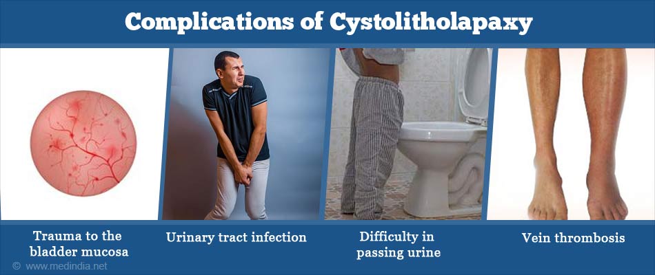 Complications of Cystolitholapaxy Complications of Cystolitholapaxy