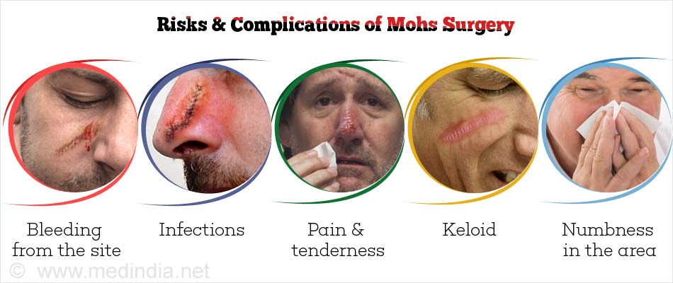 Risks & Complications of Mohs Surgery Risks & Complications of Mohs Surgery