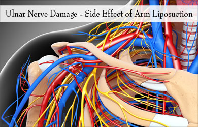 Risks in Arm Liposuction � Ulnar Nerve Damage Risks in Arm Liposuction � Ulnar Nerve Damage