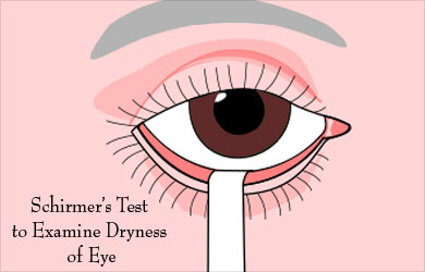 Schirmer's Test Schirmer's Test