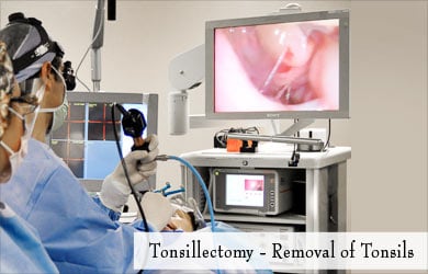 Tonsillectomy Tonsillectomy