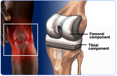 Total Knee Replacement Total Knee Replacement
