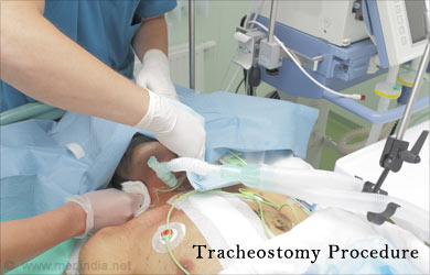 Tracheostomy - Surgery Tracheostomy - Surgery