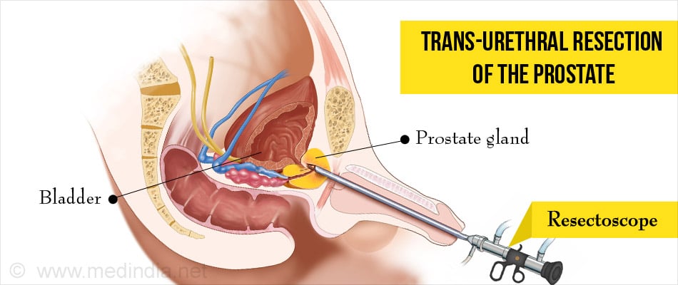 tur prostate procedure)