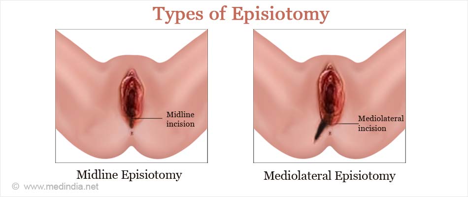 Episiotomy Types Risks Complications