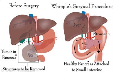 Whipple Procedure is a Type of Partial Pancreatectomy Whipple Procedure is a Type of Partial Pancreatectomy