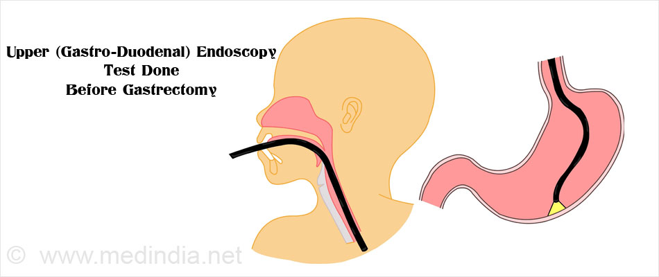 Upper (Gastro-Duodenal) Endoscopy Upper (Gastro-Duodenal) Endoscopy