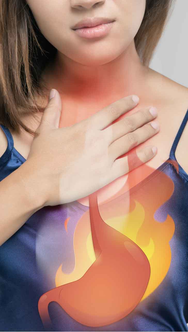Risk of Acid Reflux