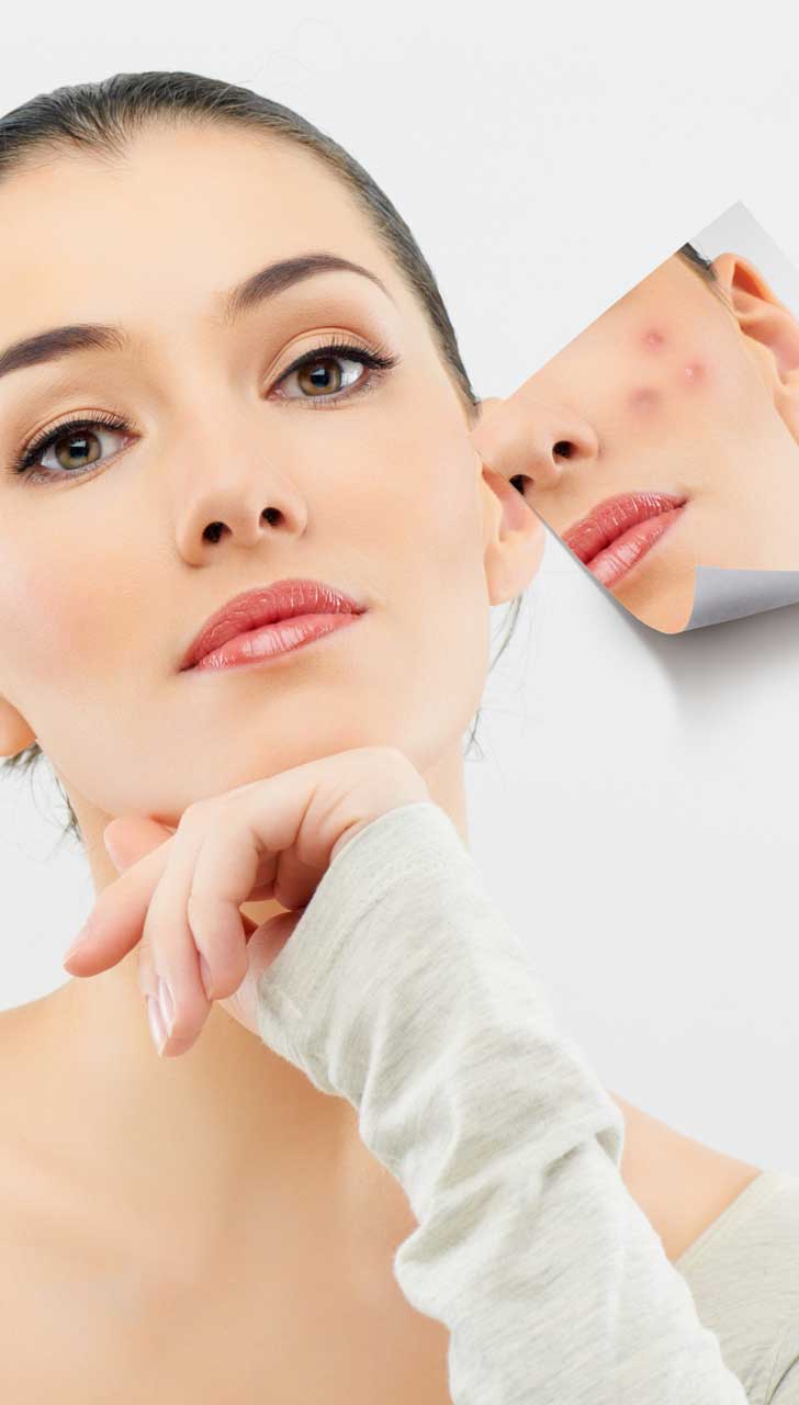 Turmeric Fight Acne
