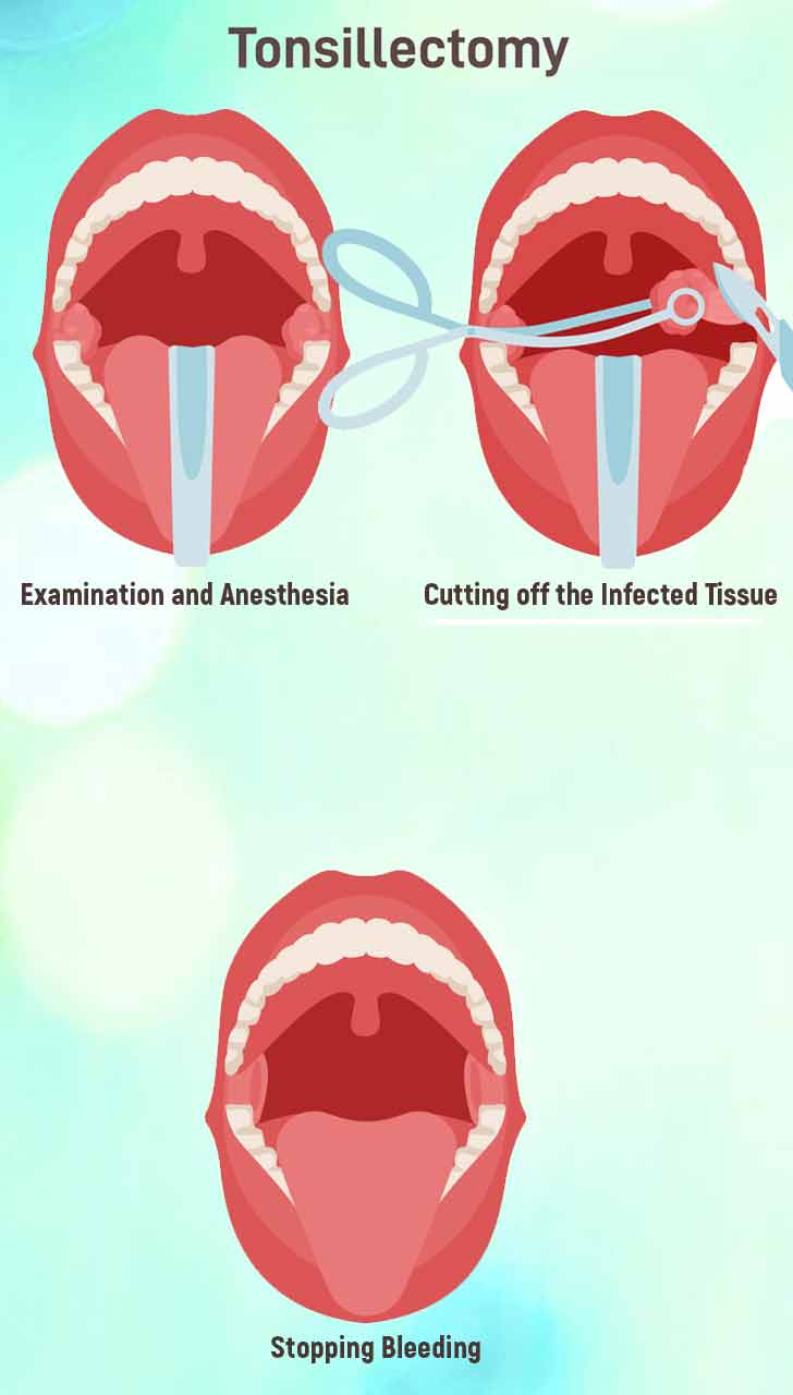 When is Tonsillectomy Needed